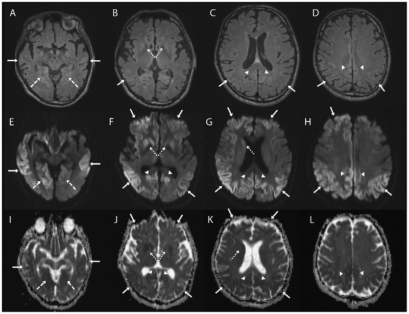 Prion Diseases FIGURE 4-6 Axial brain MRI sequences in a patient with sporadic disease.