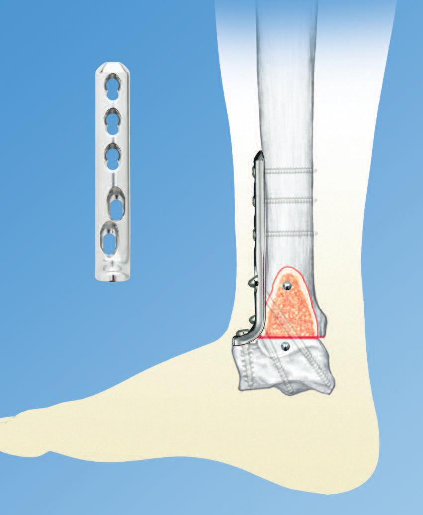 LCP Anterior Ankle Arthrodesis Plates.