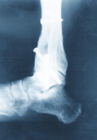 for arthrodesis of the ankle joint and