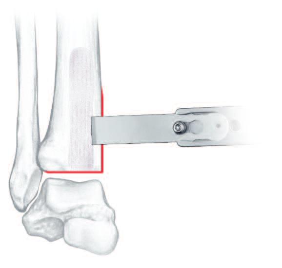 56 16 mm Chisel Blade Use a chisel and a 16 mm chisel blade to crack the anterior cortex of the distal tibia.