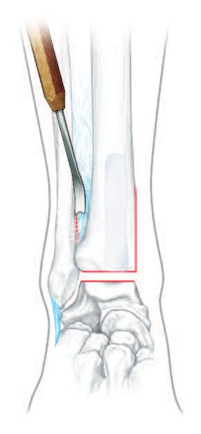 Surgical Technique continued 4 Osteotomy and resection fibula Osteotomize the fibula and