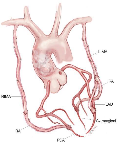 Multiple Arterial Grafts Better than veins because Live conduit (NO & PGI-2 secretion Less intimal proliferation