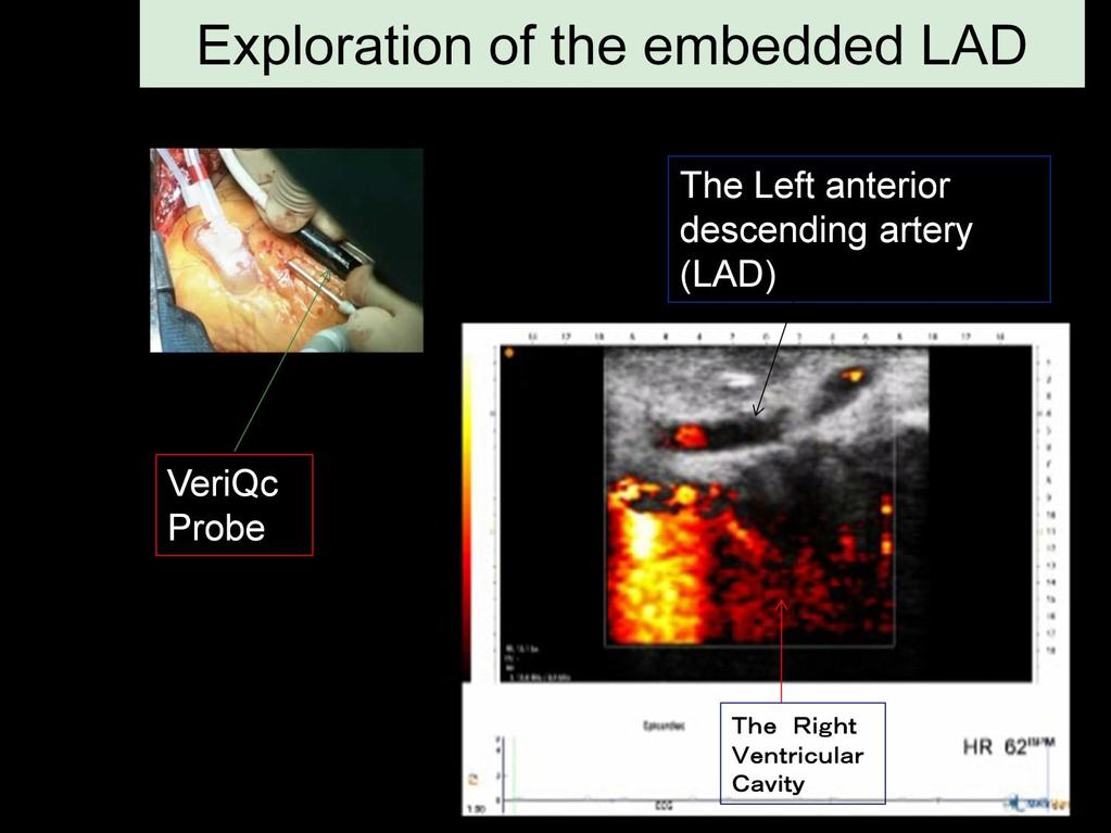 According to the findings by VeriQc, the anastomosis site of LITA to LAD was chosen at a more distal site