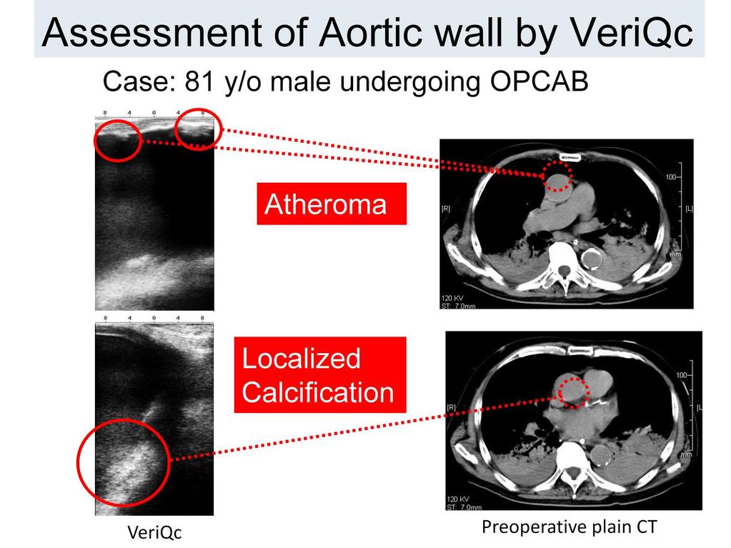 VeriQc can be used to examine the ascending aorta to detect small atheroma plaque and