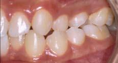 7 Some authors recommend that the final gutta percha root filling should not be placed until orthodontic treatment is complete; the root canal being filled with a non-setting calcium