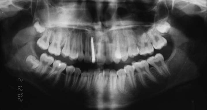 The patient was still attending the paediatric dental department for review of the upper right central incisor, which had been asymptomatic since placement of the root filling.