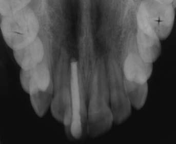 Intra-oral assessment (Figures 3, 4, 5, 6 and 7) Bimaxillary proclination; Mild mandibular arch crowding (approximately 3 mm); Mild maxillary arch crowding (approximately 4 mm); Molar relationship