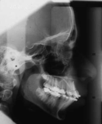 Periapical view of the upper right central incisor 3 months after placement of orthodontic appliances. Figure 14. Mid-treatment DPT. Figure 13. Mid-treatment lateral cephalogram.