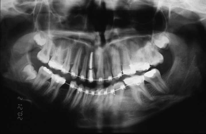The patient was treated with pre-adjusted edgewise appliances with Class II intermaxillary elastics. His treatment took 21 months until debond.