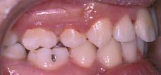 Towards the end of treatment a residual space of 0.5 mm was present distal to the upper right central incisor.