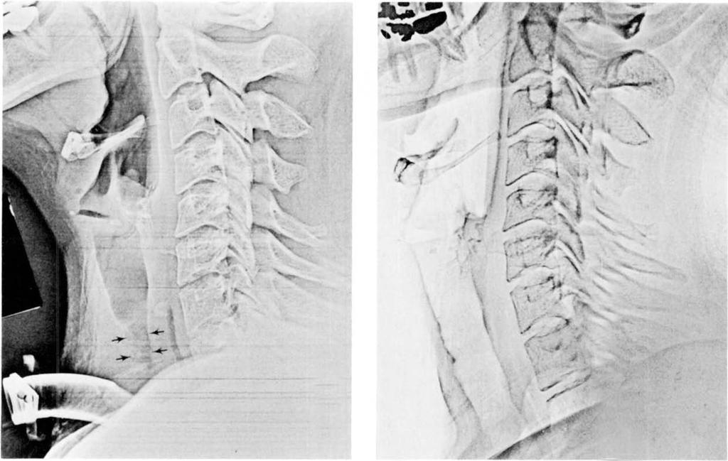 54 The Annals of Thoracic Surgery Vol 35 No 1 January 1983 A B Fig I. (A) Lateral xeroradiograph of a 23-year-old woman with an acquired subglottic stricture (arrows).