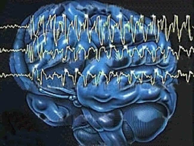 EEG Diagnosis of Seizure Intermittent versus