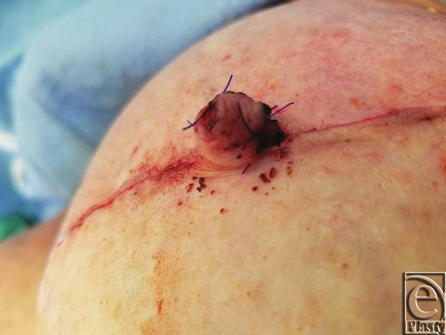 HENDERSON ET AL Figure 8. Completed rectangle-to-cube nipple flap. DISCUSSION Breast reconstruction has shown considerable evolution over the past century.