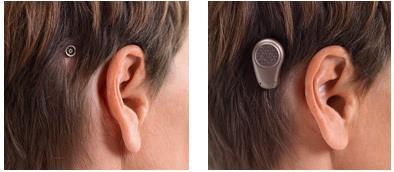Bone Anchored Hearing Aid (BAHA) A sound processor is