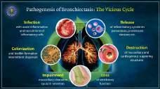 CMAJ 2017 BRONCHIECTASIS Definition: Abnormal and permanent dilation of bronchi.