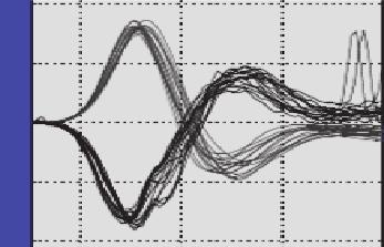 attheendoftheacutestage(about6minutes),the horizontal nystagmus changes direction, and the eye velocity curve regains its normal