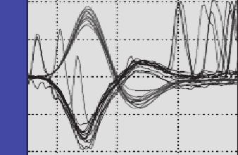 Head velocity: from 14 to 19 ( /sec). (b) Spontaneous nystagmus.