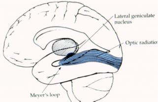 Fibers from cells in the LGN enter the optic radiations, sweep around the lateral side of the lateral ventricle