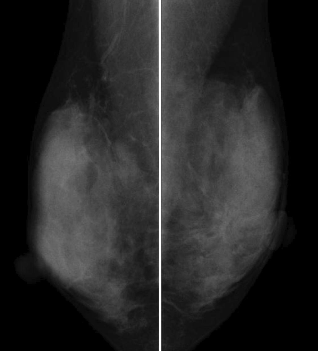 Fig. 2: This is an example case of benign mass with spiculation. A women in her 40s presented to the clinic with abnormal finding in screening mammography.