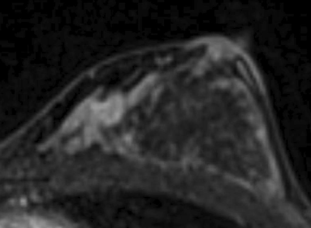 Fig. 4: This is an example case of benign mass with spiculation. A women in her 40s presented to the clinic with abnormal finding in screening mammography.