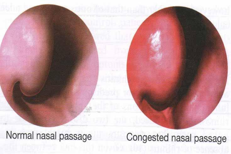 Mast cells IgE Histamine Leukotrienes Prostaglandins Bradykinin, PAF Immediate rhinitis symptoms: - Itch, sneezing - Watery discharge - Nasal congestion