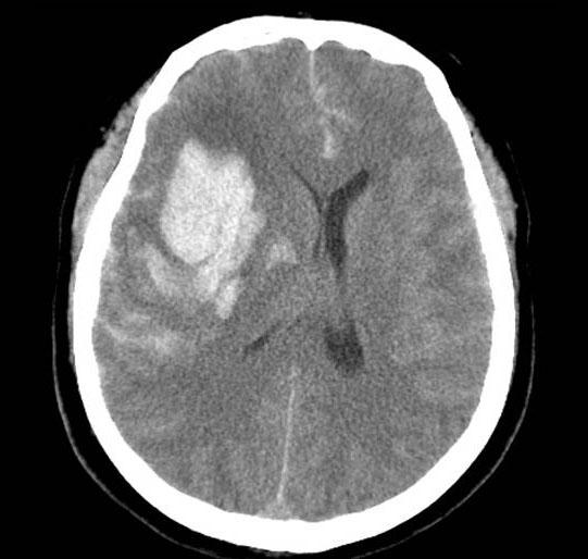 RUPTURED MCA ANEURYSM WITH INTRACEREBRAL HEMATOMA A B A B Fig.