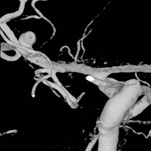 Right three-dimensional digital subtraction angiogram (D-DSA) shows the rupture point of the middle cerebral artery (MCA) bifurcation aneurysm projecting superiorly (B). outcome and another.
