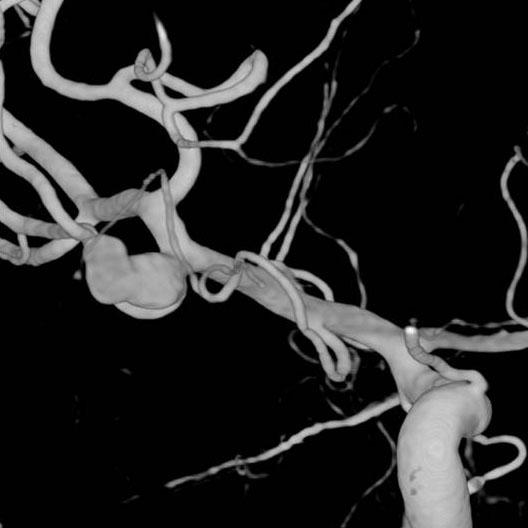 D Outcomes for patients with ruptured MCA aneurysms with ICH have been suggested to be worse, compared with SAH cases without ICH.