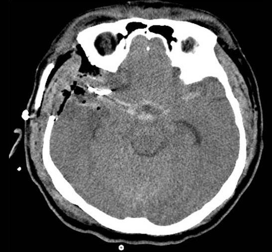 severe clinical grade on admission, severe brain swelling, and high rebleeding rate before aneurysm obliteration.