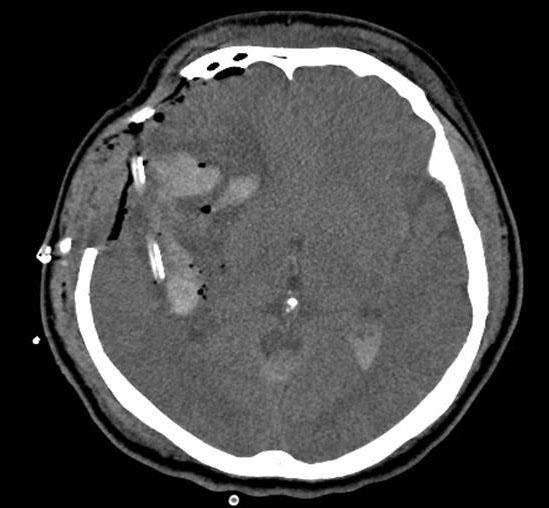 0) reported a better outcome for patients having an ICH with a hematoma volume of less than 40 cm when a hematoma evacuation and aneurysm obliteration are performed. In our cases, 84.