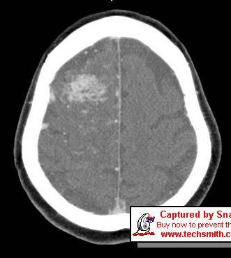 Brain CT focus on Routine (4/06) A large