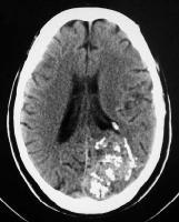 Arteriovenous Malformation(2) CT imaging of a brain AVM can show an isoattenuating-tohyperattenuating hemispheric mass.