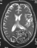 Arteriovenous Malformation(3) MRI: Typical unruptured AVM appears as a tightly packed or loose tangle of vessels.
