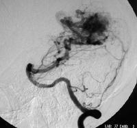 Arteriovenous Malformation(4) Conventional cerebral angiography is the criterion standard for the evaluation of AVMs.