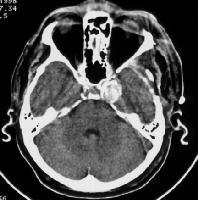 Brain, Aneurysm(2) Finding often supported by the demonstration of an aneurysm in the area of maximum clot localization or maximum amount of subarachnoid blood.