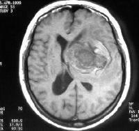 Brain, Aneurysm(3) MRI: Intracranial aneurysms: an area of flow void larger than the healthy vessels in that region.