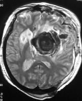 T1-weighted MRI : A large intracerebral mass with a significant amount of surrounding edema is depicted.
