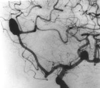 Brain, Aneurysm(4) Cerebral angiography remains the definitive preoperative