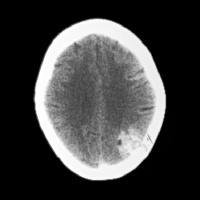 Large, right frontal and left occipital cavernous angiomas Axial NECT: a large heterogeneousappearing lesion in the right frontal region.