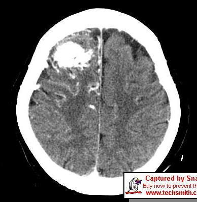 Image-Brain CT focus on Routine (3/26) There is precontrast subtle
