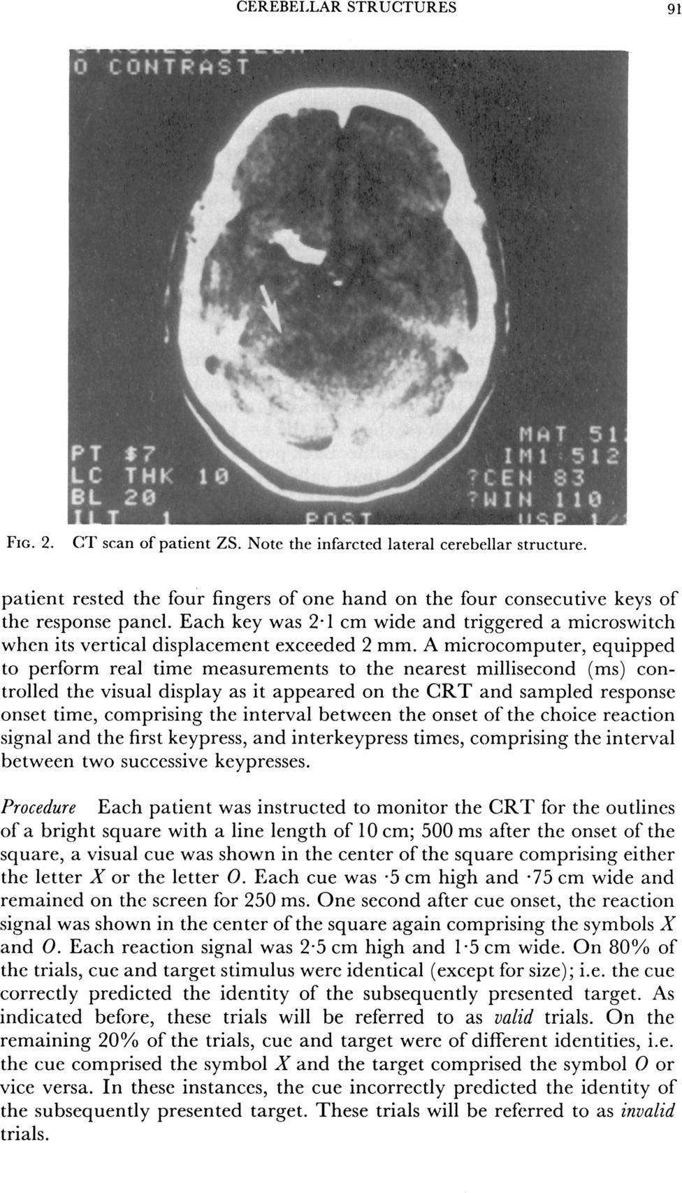 CEREBELLAR STRUCTURES 91 FIG. 2. CT scan of patient ZS. Note the infarcted lateral cerebellar structure. patient rested the four fingers of one hand on the four consecutive keys of the response panel.