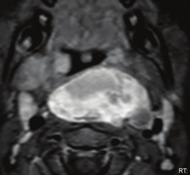 These were interpreted radiologically as reactive lymph nodes with no suspicion of malignancy.