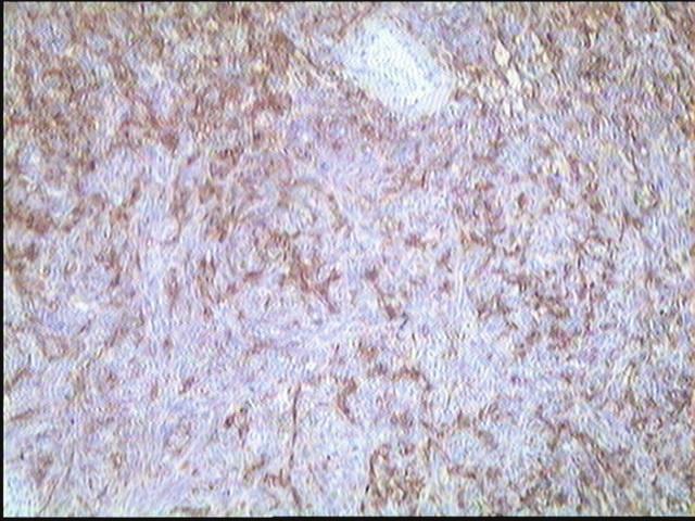 within the stroma of the tumor which did not show abnormal features or evidence of malignancy. On immunohistochemistry, the tumor cells were positive for bc12 and focally positive for Mic2 and EMA.