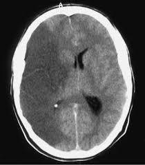 Ischemic Stroke NO strong data yet May have a role in reducing cerebral edema prior to malignant MCA