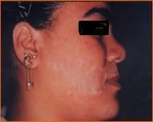 Fig 20: slight hyperpigmentation at the site of melanocytes transplantation on dermabraded skin.