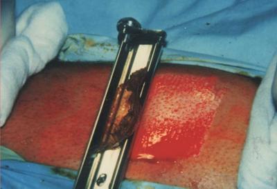 Fig 2: obtaining the split skin graft with the skin graft knife from the medial aspect of the thigh. The size of the graft was justified according to the size of the depigmented area.