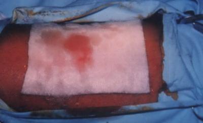The slightly bleeding doner area was covered with sofratulle ( lanolin gauze dressing containing 1% framycetin sulfate) or Kaltostat sheet (an absorbent fibrous fleece composed of the sodium and
