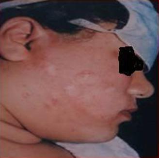 Fig 6: Superficial dermabrasion of the depigmented area.