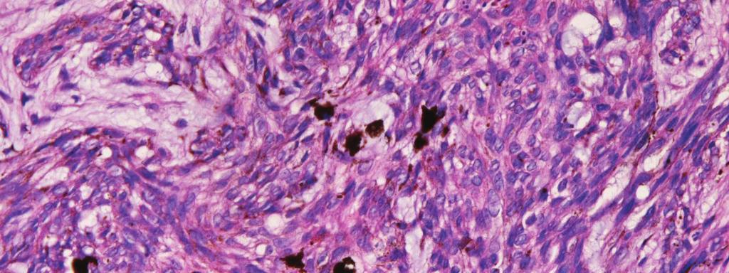 Immunohistochemically, the tumor cells were positive for cytokeratin (CK) AE1/3, 255 Figure 3. High power view.