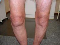 Case 1 Help Your Bilateral Knee Osteoarthritis by soni2006, Hubpages.